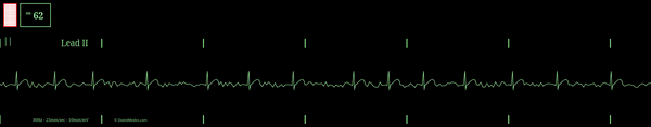 EKG monitor simulation of Atrial Fibrillation at a rate of 65bpm.