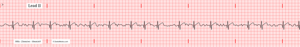 The Atrial Fibrillation (AFib) EKG/ECG