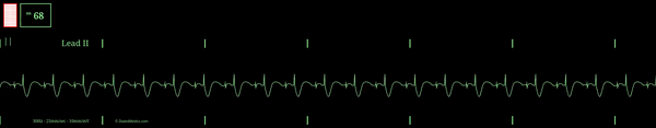 Simulated cardiac monitor capture of an AV Pacemaker.