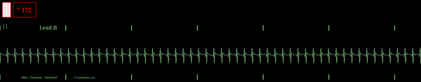 EKG monitor simulation of Supraventricular Tachycardia with a rate of 172bpm.