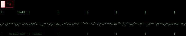 EKG monitor simulation of Atrial Fibrillation at a rate of 152bpm.