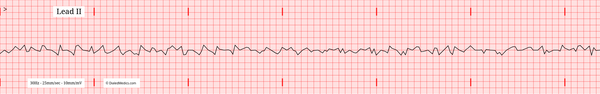 The Ventricular Fibrillation (VFib) EKG/ECG