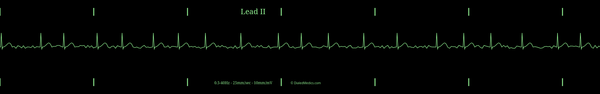 Example EKG monitor capture of an Atrial Fibrillation with a heart rate around 70bpm.