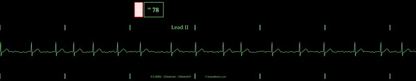 A capture of Dialed Medics ECG generator / simulator output showing Atrial Fibrillation.