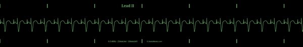 Example EKG monitor capture of an Atrio-Ventricularly Paced Rhythm with a rate of 70bpm.