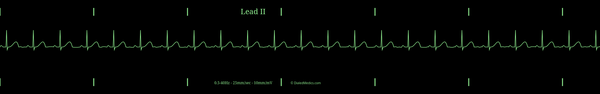 Example EKG monitor capture of a Normal Sinus Rhythm with a heart rate of 70bpm.