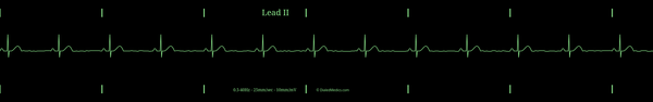 Example EKG monitor capture of a Sinus Bradycardia with a heart rate of 40bpm.