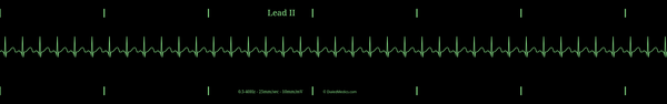 Example EKG monitor capture of a Sinus Tachycardia with a heart rate of 120bpm.