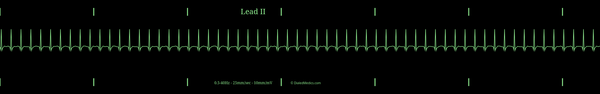 Example EKG monitor capture of a Supraventricular Tachycardia (SVT) with a heart rate of 190bpm.