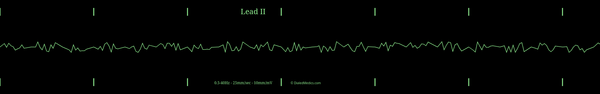 Example ECG monitor capture of a Ventricular Fibrillation.