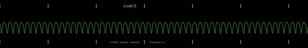 Example ECG monitor capture of a Ventricular Tachycardia with a heart rate of 167bpm.